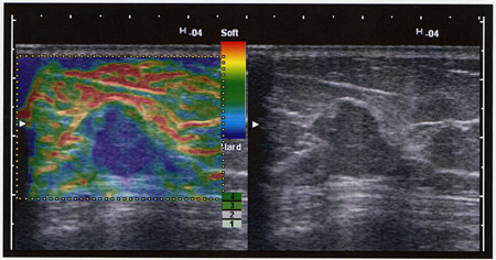 Real-time Tissue Elastographỷ摜