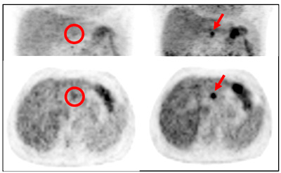 ]PET/CTijDiscovery PET/CT 600iEj̉摜