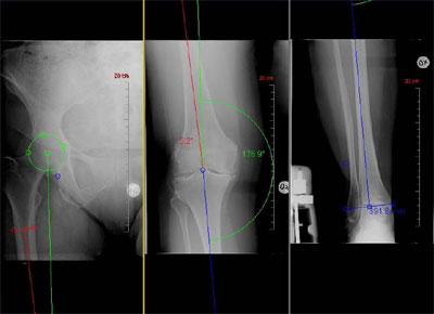 整形外科診療に特化した計測イメージ(左から、大腿、膝、足首)