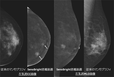 左から2番目の画像内に2つの矢印で記した病変部のうち、下方は従来のマンモグラフィでも描出されているが、上方はSenoBright搭載装置がより鮮明に描出。