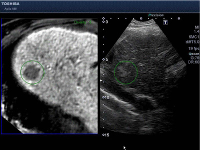 EOB・プリモビスト造影剤を用いたMRI検査により検出された病変のFusion画像