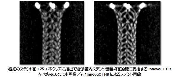 極細のステントを1本1本クリアに描出でき頭蓋内ステント留置術を的確に支援するInnovaCT HR