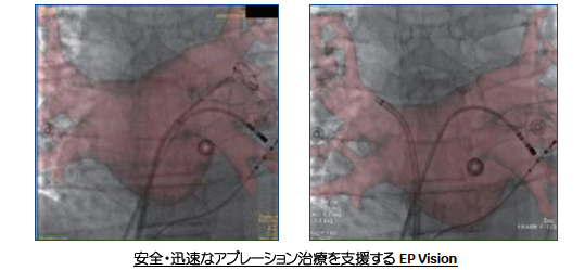 安全・迅速なアブレーション治療を支援するEP Vision