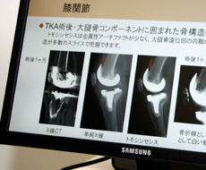 膝関節におけるCT,単純X線,トモシンセシスの画像の比較。トモシンセシスは金属アーチファクトがなく,明瞭に描出される。