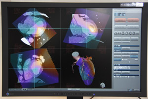CT-SPECT 3D Fusion