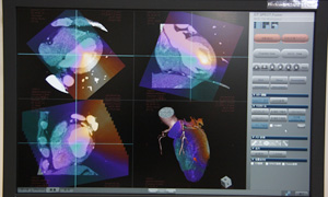 新アプリケーション「CT-SPECT 3D Fusion」
