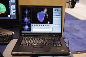 CT-SPECT 3D Fusion