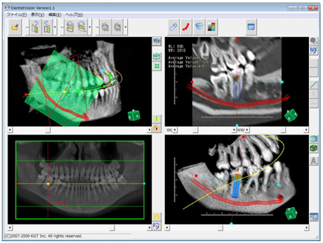 歯科用DICOMビューア 『DentistVision』 (デンティスト・ビジョン)