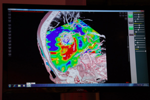 4D Brain perfusion