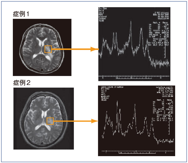 図4 MRSの脳腫瘍の鑑別診断への応用(症例1,2)