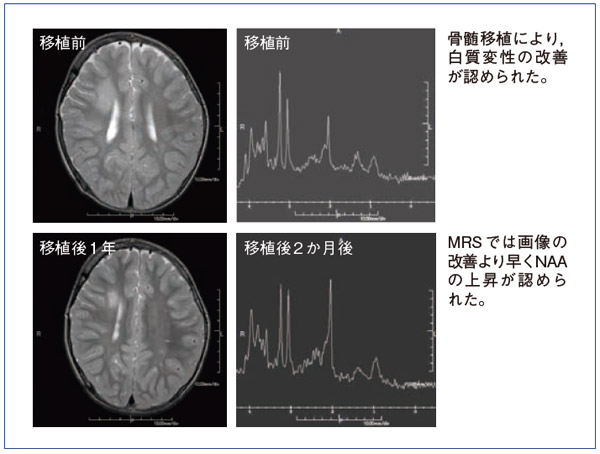図5 MRS の副腎白質ジストロフィ症例への応用