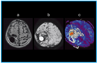 }1@arteriovenous malformation