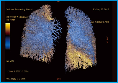 }11@Ǘ7FxǂLung perfusion imagingiJj