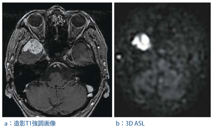 }2@3T MRIɂ cavernous sinusɐmeningiomȁǗ摜