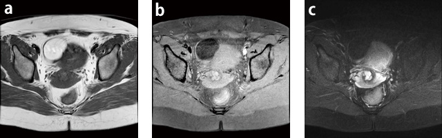 Ǘ1FEdelmoid cyst