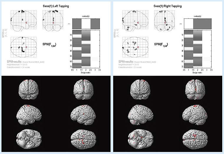 SPM\tgEGAɂfMRI͌