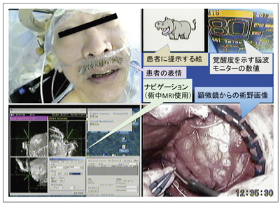 }6@IEMASiIntraoperative Examination Monitor for Awake SurgeryFopɂp@\VXej opł̌@\̃j^Oɂi҂̕\C҂ɒ񎦂CXgC]gj^̐lȂǁjW񂵂ĕ\BpɁCpO}bsO摜ƂɌ@\^@\mFĂB̈ł́CCXgȂdChi50HzC3msj^Ch^^C~Oɖ̂𓚂邩Ȃǂ̃eXgsi}6ł͢JojBɂCh^ɁC邩Cт镔邩ȂǁC̏oB