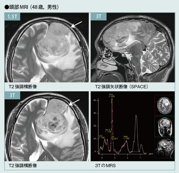 MRI