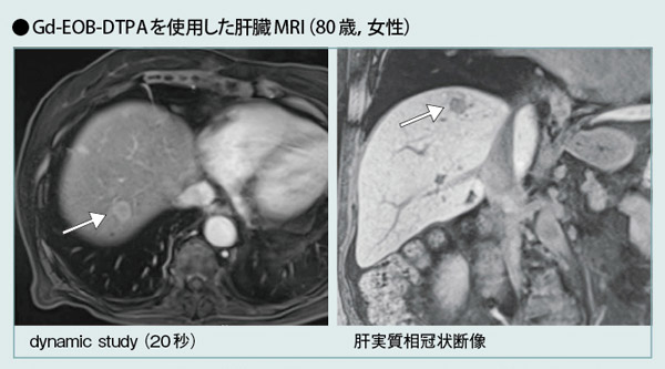 Gd-EOB-DTPAgp̑MRI