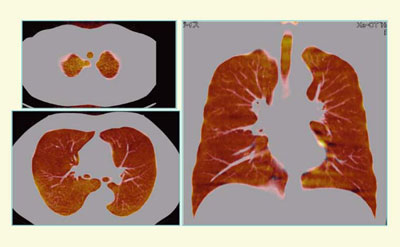 }7@Ǘ1i60΁CjCiҁjFThree-material decomposition摜