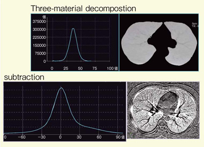}9@Ǘ1FThree-material decompositionsubtractionCTlqXgO̔r