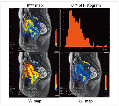 }3@Ktrans , Ve , kep map and Histogram for Cervical CanceriMAGNETOM Skyra Ver D11j iCourtesy of Kyoto University Hospital, Japan.j