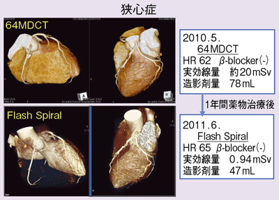 }3@Ǘ1F64MDCTDefinition FlashiFlash Spiral Cardioj̔r