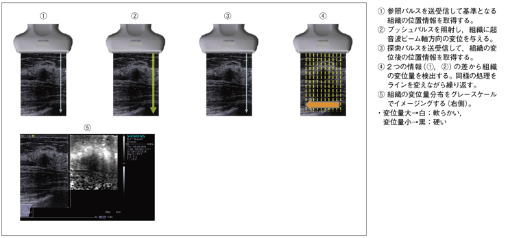 }3@Virtual Touch Tissue Imaging̓vZX