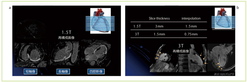 }15@Whole heart late gadorinium enhancement@ aF1.5TCF3T