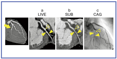 }4@Ǘ2F60ΑCjCCAGƂ̑ւꂽ aFCPRCbFTugNV摜iW.I.P.jCcFCAG摜iYoshioka, K., Tanaka, R. : Subtraction Coronary CT Angiography for the Evaluation of Severely Calcified Lesions Using a 320-Detector Row Scanner. Curr. Cardiovasc. Imaging Rep., 4E6, 437`446, 2011.苖𓾂Ĉp]ځj