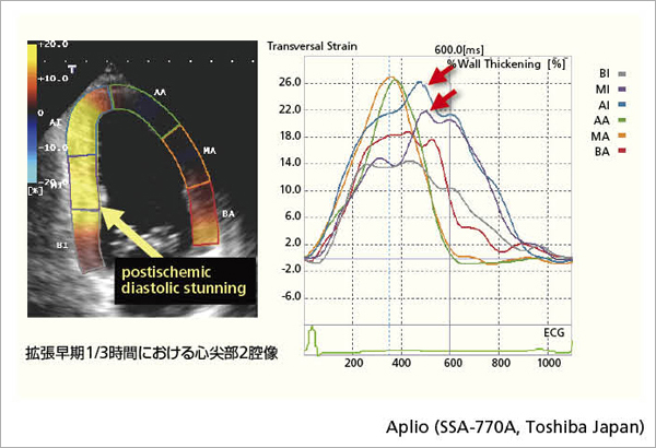 }5@54΁CjCs苷Sǂ̋ɔ6Ԍ2D speckle tracking imageiS땔2ofʁCg1/3ԁjƁCtransversal strainȐ