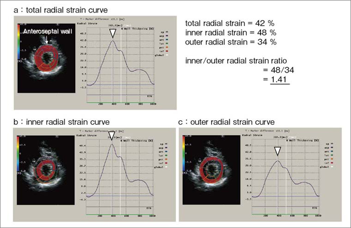 }1@radial strain Ȑ