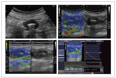 }7@}6ǗAplio500ɂElastography